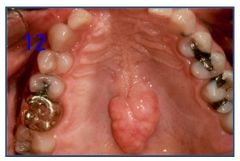 o	This 40 YO male presented for a routine exam. He reports that he has noticed this hard bump on the roof of his mouth for a long time. He worries that he may have a tumor because it hurts some times. He has a history of hypertension and takes Diltiazem t