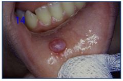 o	19 year old female. This somewhat pedunculated mass of the lower right lip mucosa has been present intermittently for more than 8 weeks. It is slightly tender and has a tingling sensation associated with it. There are no other similar oral lesions. (MU,