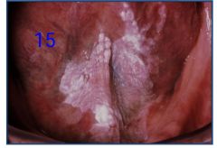 o	60 year old male. This man’s dentist noticed an asymptomatic white plaque of his oral floor during a routine annual exam. The patient smokes two packs of cigarettes daily and has been doing so since his late teens. He has COPD and emphysema.