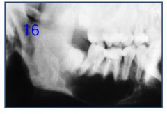 o	16 year old male presents for evaluation of painless swelling of retromolar pad area of right mandible. Large radiolucency of mid-portion of mandible is nontender and nonexpansile. Overlying mucosa is normal. Duration: unknown. What is your differential