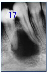 o	40 year old male with painless, sessile bulge or bosselation of his right mandibular first premolar region. It has not enlarged since he first noted it 5 months earlier.