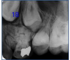 o	8 year old female. This irregular radiopacity was noted above the crown of the impacted maxillary left premolars during a routine dental visit. She had not been to the dentist for more than two years. There is a cortical swelling over the site and the a