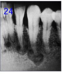 o	40 year old AA female with this non-expansile radiographic finding. The teeth are all vital.