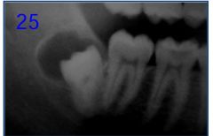 o	21 year old male. This was discovered during a routine oral surgical examination. The patient was referred for removal of several impacted third molars. The area is asymptomatic and nonexpansile.