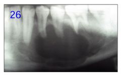 o	A 17 y.o. Asian male presents to ER with CC of a bee sting. Upon examination, the patient reports pain in left mandible.  After radiographic exam the patient is sent to the dental ER.