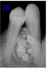 o	48 year old female. This lesion was noted between 27 & 28 during a routine dental visit. She had not been to the dentist for more than15 years. There is a cortical swelling over the site and the area is asymptomatic.