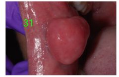 o	30 year old male. This somewhat pedunculated mass of the right buccal mucosa has been present for more than 3months. It is soft and moveable on palpation.