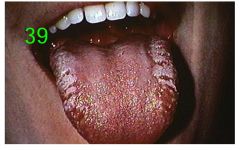 o	Chief Complaint: 22 yo female college student requests a routine examination.
o	Medical History: Patient takes tetracycline, 250 mg twice a day, for acne. 
o	Clinical Findings: Bilateral white plaques are present on the middle and anterior portion of 