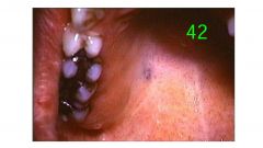 o	Chief Complaint: Patient's parents request a routine examination.
o	Clinical Findings: A solitary, well-circumscribed lesion is present at the junction of the hard and soft palate. The lesion is thickened, firm to palpation and non-tender. It is fixed 
