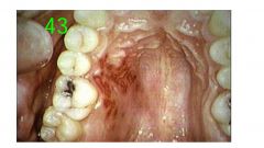 o	Chief Complaint: 29 year old patient complains of painful oral ulcers of five days duration. The patient has not noticed blisters. The lesions have occurred five times previously, always in the same location. The lesions resolved in two weeks for each e