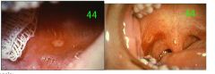o	Chief Complaint: The patient complains of oral discomfort. She has had multiple oral ulcers constantly for the past three years. Individual ulcers heal in seven to ten days. No treatment has helped the lesions. The patient reports that the ulcers have o