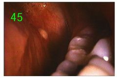 o	Chief Complaint: The patient is concerned about a persistent, non-tender lesion first noticed one year ago.
o	Clinical Findings: The lesion is a well-circumscribed, pale, submucosal nodule, 4 mm in diameter, located on the left posterior lateral border