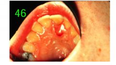 o	Chief Complaint: Patient complains of pain and swelling associated with a front tooth.
o	Clinical Findings: A fluctuant compressible soft tissue swelling is associated with the lingual of the affected area. Probing of the swelling causes discharge of p