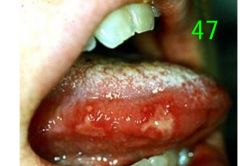 o	Chief complaint: Young person with painful oral ulcers of sudden onset
o	Medical History: Blisters on hand and feet and had a fever. No other medical problems.
o	Clinical Findings:  Multiple red macules that form vesicles which rupture and ulcerate.