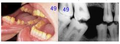 o	Chief Complaint: 25 year old with sensitive teeth and dislikes the color of his teeth
o	Clinical Findings: Reduced enamel thickness, abnormal contour and absent interproximal contact points evident