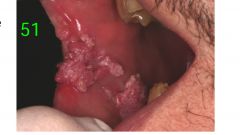 o	40 year old HIV positive male on HAART therapy. On exam you find these lesions on the buccal mucosa and  he has similar lesions on the soft palate.