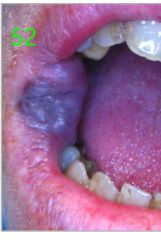 o	55 year old female
o	Lesion of right anterior buccal mucosa, commissure area present since childhood