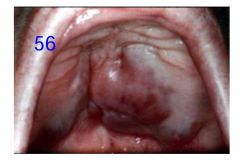 o	This 72-year-old woman had just recovered from an episode of herpes zoster in her sacral region when she noticed soreness of her left mandible. Her dentist had removed a tooth in this area one year earlier.  Antibiotics given by her physician did not re