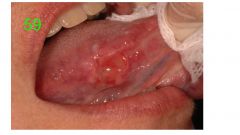 o	36 y o female with chief complaint of an area of “soreness” on the tongue
o	A raised, rough and somewhat papillary lesion noted on the dorsal aspect of the tongue 
o	Patient’s history was significant for lichen planus