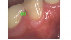 o	40 year old female with an asymptomatic lesion on the radiograph. Teeth are vital