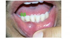 o	This 23 yo female presented with a swelling of the right maxilla for 2 weeks.
•	Description:
o	One large irregular shaped radiolucent multilocular lesion located around the root of tooth #6 displacing teeth #7 and #5