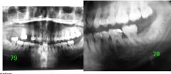 o	A 29-year-old male presented because of a slowly enlarging anterior mandible. The swelling was noted several weeks after an auto accident. He had no symptoms.
o	One large well defined, corticated multilocular radiolucent lesion associated with the mand