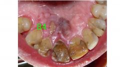 o	A 19 year-old female presented with a history of slowly enlarging palatal mass over the past several years. 
o	She has not been to the dentist in 5 years
o	Patient has asthma controlled with Flovent
•	Description: 
o	slowly enlarging palatal mass in