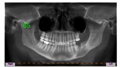 o	72 year old male. 
o	Treated (surgery and radiotherapy) 8 years ago for squamous cell carcinoma of the right ventral tongue. 
o	Has developed this area over the last year
o	The lower portion of the buccal lesion is indurated; the lesion is asymptomat