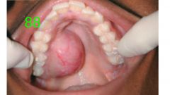 o	A 60-year-old male was referred to the WU clinic for evaluation of a mass in his tongue which the patient felt was just infection.
o	The lesion was first noticed by his dentist two months ago and considered to be due to local trauma caused by a “sharp-