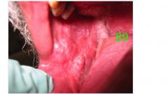 o	38 year old male 
o	This man has had a painful area of his tongue for more than 3 months. 
o	It has remained unchanged since it first appeared.   
o	He remembers biting his tongue at the start of the lesion. 
o	He has been diagnosed with ulcerative 