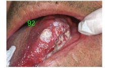 o	44 year old female
o	 This woman experienced a sudden-onset sharp pain of her palate 1 week ago. 
o	At that time she noticed a “lump” in the region, which ulcerated shortly thereafter. 
o	Pain has persisted unchanged
o	She has a history of sarcoidos