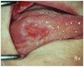 o	A 60 year old male has an appointment at your office for a COE
o	He has a 30 year history of smoking and no other medical problems
o	Indurated lesion of the lateral border of his tongue. 
o	You also note a rock hard left submandibular lymph node.