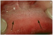 •	Clinical Information: 
o	24 year old male presents for routine dental exam. Lower lip whiteness has been present for at least 7 years, is asymptomatic and has not changed in “many years.”
•	Description:
o	Diffuse leukoplakic lesion located on lower l