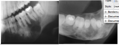 o	A 17-year-old male presented with a persistent swelling of his jaw of several months’ duration. He had no associated pain or paresthesia. He had no history of jaw infection or trauma. His systemic health was excellent. All teeth tested vital.
o	One, La