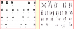 Extra Philadelphia chromosome

trisomy 8

isochromosome 17q 

trisomy 19
