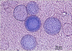Rhinosporidium seeberi spherules - > 80 uM
Larger than Coccidioides spherules