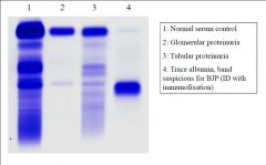 Urine Protein Electrophoresis
(Urine Concentrated 80x)