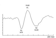 1. N1 (N75) = initial negative deflection
P1 (P100) = positive deflection (most important)
N2 (N145) = second negative deflection

2. High sensitivity for anterior visual pathway lesions (pre-chiasmal). Poor sensitivity for lesions of the postchia...