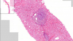 Liver biopsy
- Bluish areas of inflammation = portobiliar spaces
- Small necrosis of hepatocytes = Piece-meal necrosis
- Ground glass cells

Diagnosis?
Etiology?
What is ground glass cells?
What is piece-meal necrosis?
What is portobiliar...