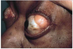 Los tejidos de la cavidad orbitaria del ojo se hinchan, y ciertos depósitos de material inflamatorio empujan el globo ocular hacia adelante. Graves: hipertiroidiso autoinmune. 

 