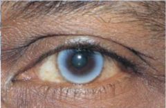 Surge en la tercera edad y se manifiesta por un color amarillo-grisáceo en la periferia corneal. Depósito de sustancias lipoides en el estroma corneal. 