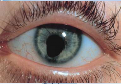 Orificio, fisura o hendidura en el iris. Falta parcial del tejido normal del ojo en el momento del nacimiento. 