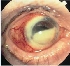 Leucocitos y fibrina cámara anterior del ojo.