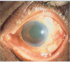 Sangre en la camara anterior del ojo. La sangre se acumula por detrás de la córnea y frente al iris.
