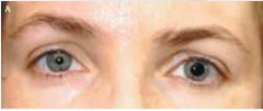 Causada por una infección vírica o bacteriana, la cual causa una inflamación y se caracteriza por una pupila tónica dilatada.