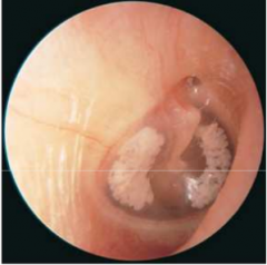 Calcificación de tejidos en el oido medio. 