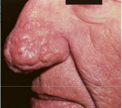 Hiperplasia de glándulas sebaceas con sobrecrecimeinto del tejido blando. 