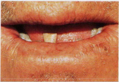 Carcinoma in situ que afecta al labio inferior. Causas: Exposición crónica a los rayos ultravioletas solares, estando también implicados el humo del tabaco y la irritación crónica. 