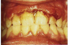Ulceras en las papilas interdentales seguido de un proceso necrosante donde se establece una pseudomembrana grisacea. 