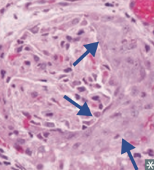 Nephritic Syndrome
- Crescent-moon shape consists of fibrin and plasma proteins (eg, C3b) with glomerular parietal cells, monocytes, and macrophages